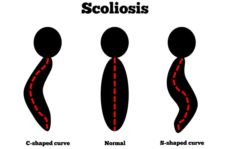Warsaw, IN scoliosis treatment